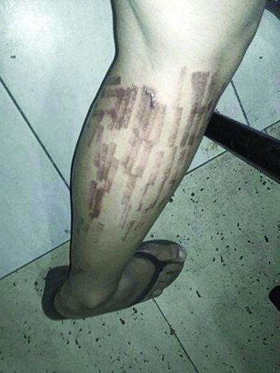 南京一女子美容院做激光脱毛美腿遭毁容