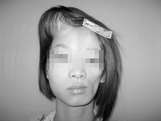 宿迁17岁女左脸塌陷 医生称或基因突变所致