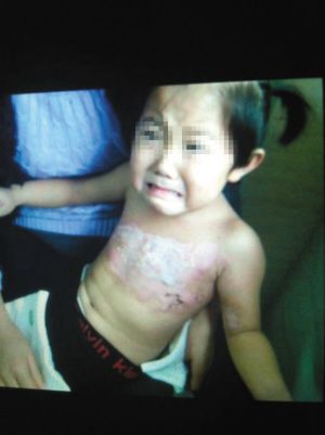 徐州老师泼开水烫伤4岁女童或影响乳房发育